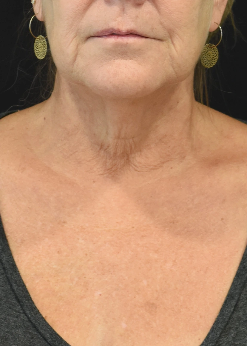 Neck Lift Patient 32 Set 1 Before