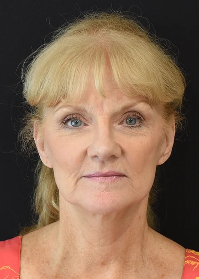 Deep Plane Facelift Patient 17 Set 1 After